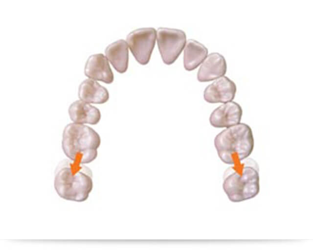 奥歯のかみ合わせの治療の際マイクロインプラントとヘッドギアは同じ目的で用いられます